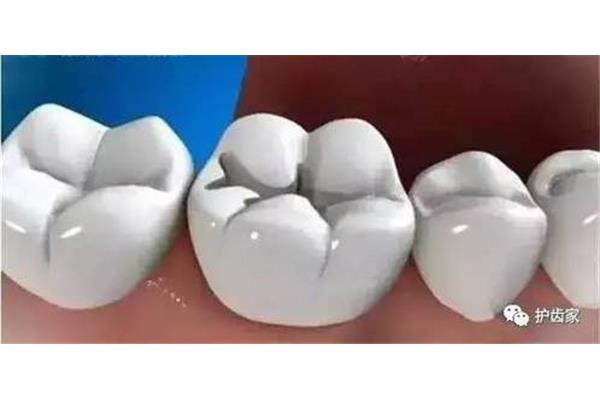 補牙材料脫落牙齒修復知多少?