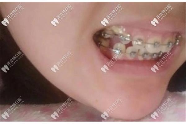 正畸牙齒帶牙套要多久? 十六歲女孩帶牙套要帶多久