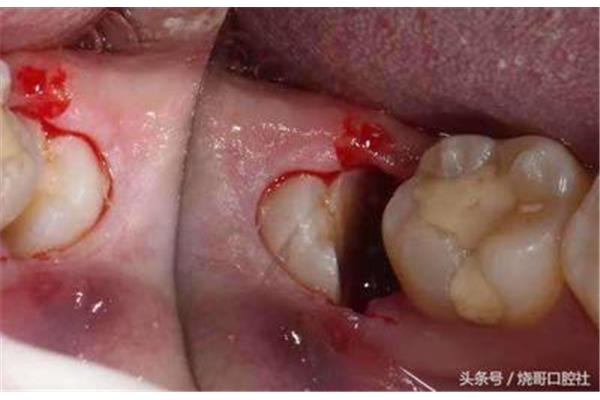 拔牙后牙齦腫痛正常嗎? 拔牙腫疼多久能恢復