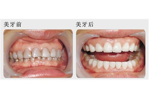 種植牙二次手術需要多長時間恢復,拔牙后幾天恢復正常