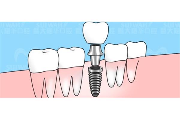 種牙需要花多長時間 種牙二期手術后多久才能裝牙冠