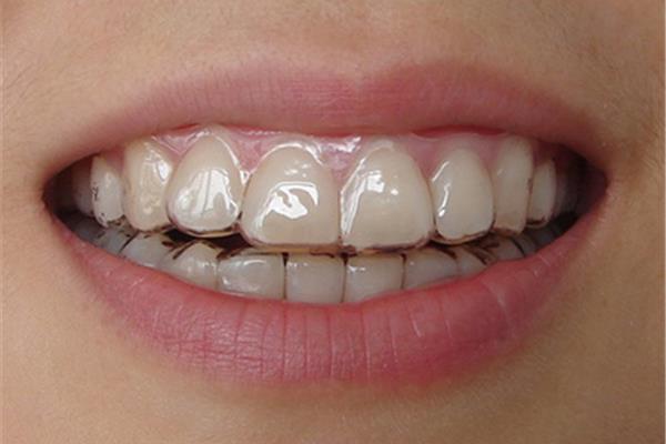 隱形矯正牙齒需要多長時間 戴隱形牙套多久可以看到效果?