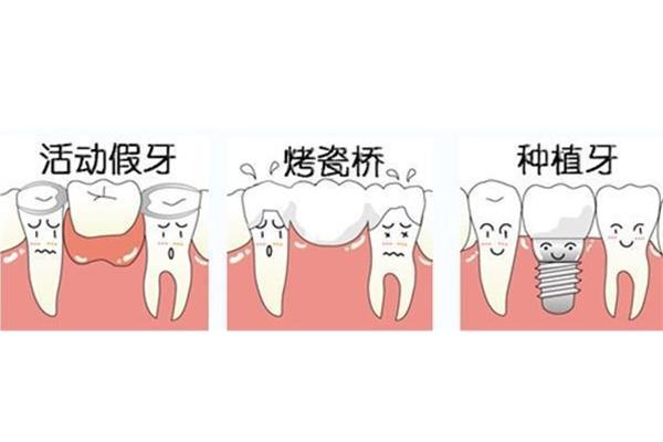 口腔沒牙能鑲牙嗎?一般不會影響鑲牙