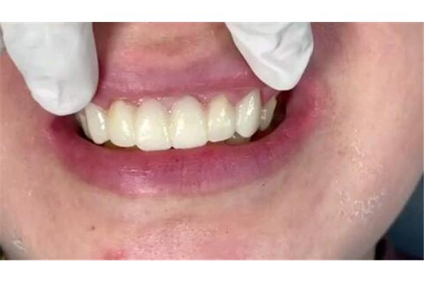 口腔醫院做臨時牙要多久?dmg臨時牙齒制作視頻