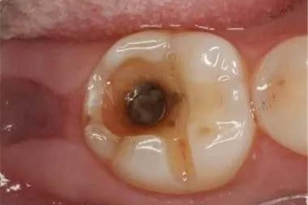 補過的牙能用多久 樹脂補牙能用多久