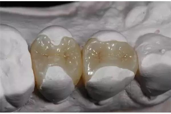 牙齒嵌體能用多久