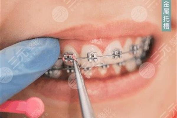 在上海做牙齒矯正要多久?專家:與方法、年齡和難度有關