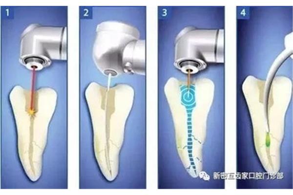 牙齒根管治療能用多久