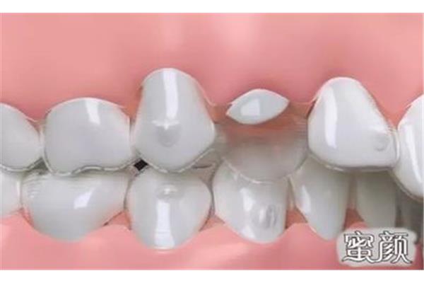 補完牙后該怎么保養牙齒? 補完牙多久可以矯正
