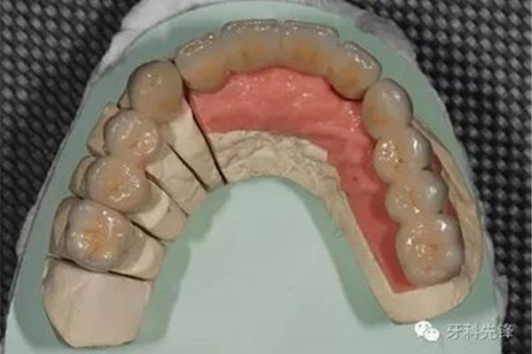 拔牙后多久可以做固定義齒,植入固定義齒需要多久?