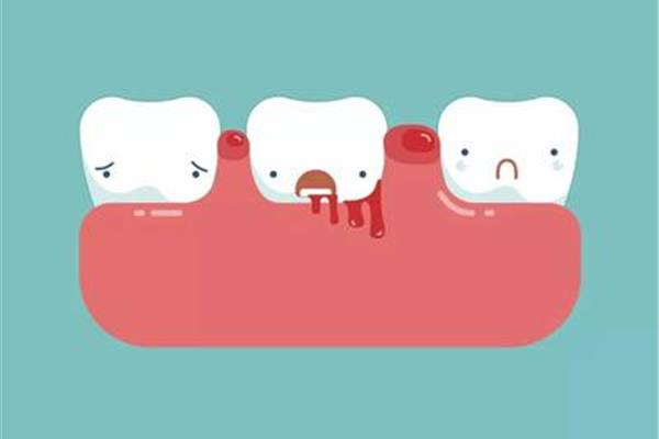 戴牙套需要多久? 牙齒矯正多久能排齊