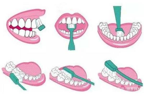蛀牙補牙后多久能刷牙
