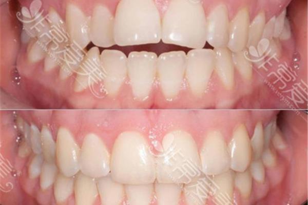 牙周病治療多久可矯牙 補牙后多久可以牙齒矯正
