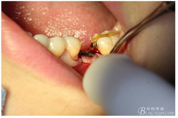 牙齒矯正需要多久時間 正畸一般需要多久
