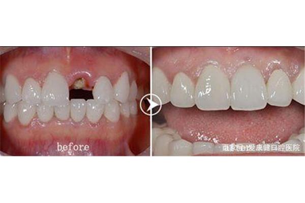 拔牙后需要多長時間恢復正常?