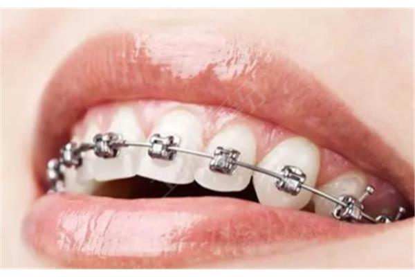 隱形矯正牙齒需要多久? 隱形矯正牙齒多久才有效果