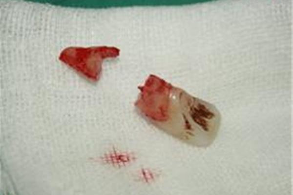 兒童牙齒外傷可能導致牙髓感染牙齒變黑