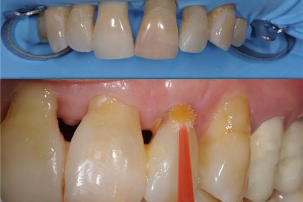 牙齒過敏怎么辦? 牙過敏時間長有什么危害