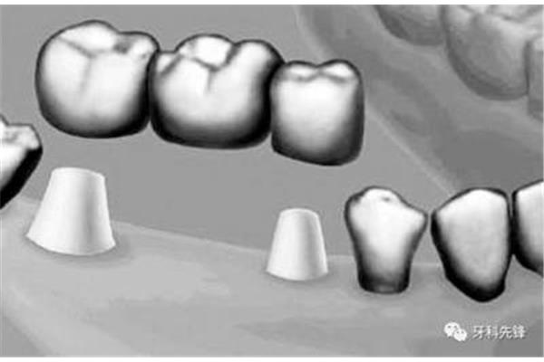 種植牙的壽命有多長? 鑲固定牙多久能適應