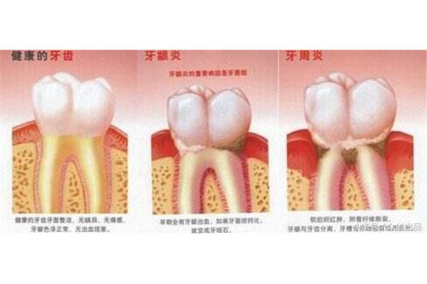 慢性牙齦炎多久會變成牙周炎,牙周炎牙齦炎多久吃藥?