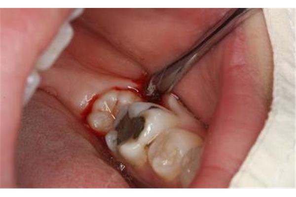 拔牙后多久能補牙? 拔智齒恢復期要多久