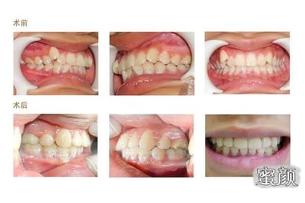 你的牙齒是否健康? 矯正牙齒要多久時間