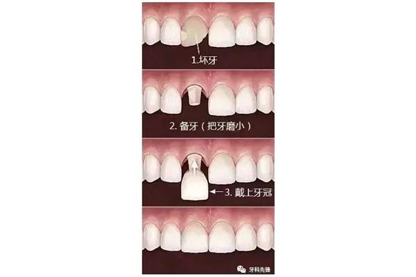 根管治療牙齒壽命多久? 牙齒做了牙冠能用多久