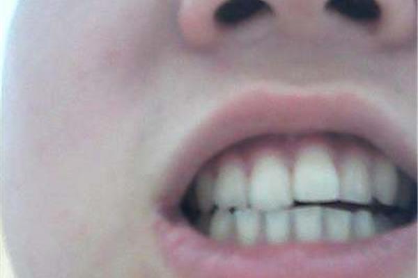 我國10歲以上牙齒不齊怎么辦?