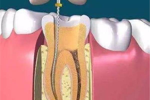 牙齒需要多長時間才能堆起來,根管治療需要多長時間才能堆起來?