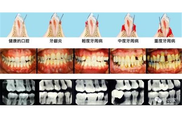 牙齒齦下刮治并漱牙一個月后牙齦為什么還腫你好?
