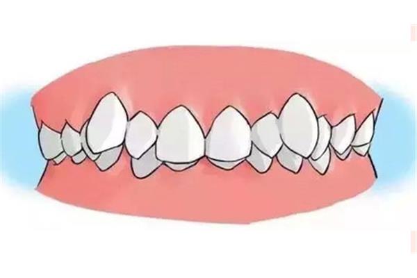矯正虎牙突出需要多長時間,兒童矯正虎牙需要拔牙嗎?