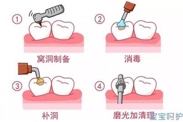 補牙洞能維持多久時間?一般牙疼要換45次藥