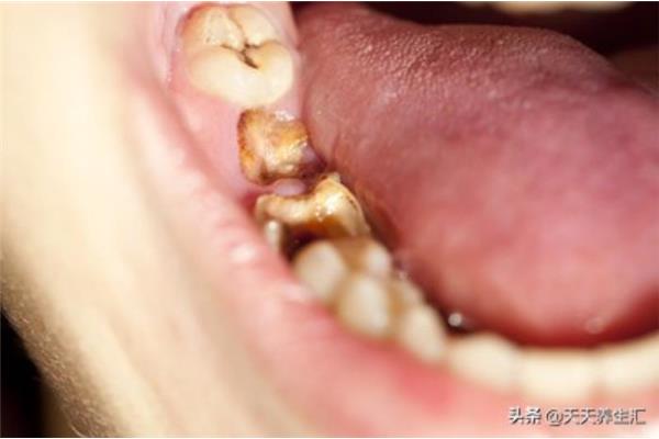 牙周病引起的牙齒若輕度松動多數能恢復正常