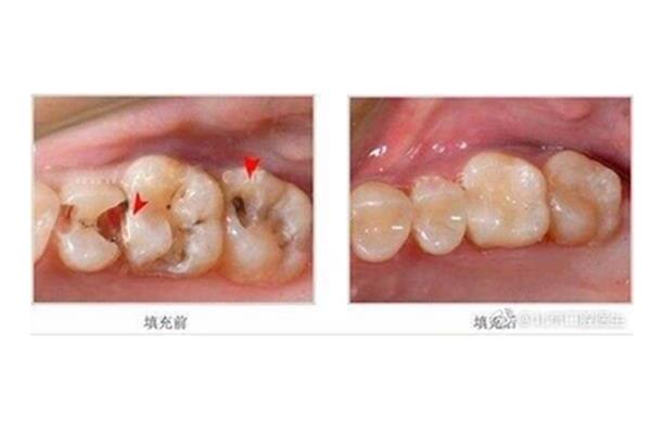 根管治療后補牙的牙齒能夠管多久?
