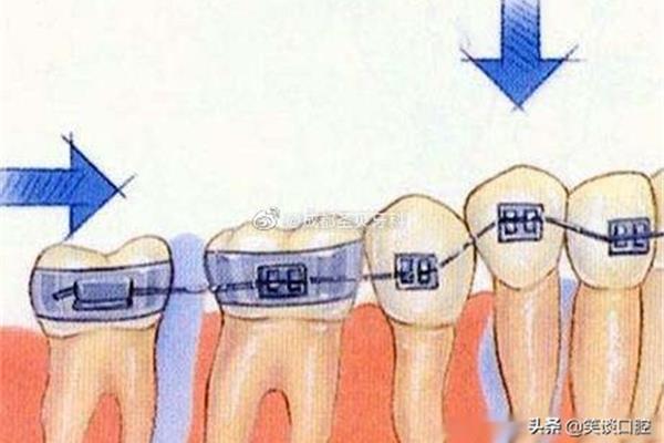 戴牙套多久牙齒有變化