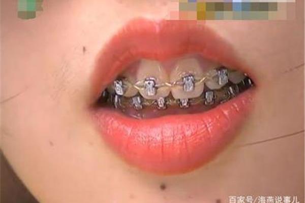 帶牙套要帶多久才能取?注意事項有哪些?