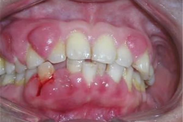 大蒜搗爛敷牙痛穴位可消腫 牙齒大牙肉痛腫了