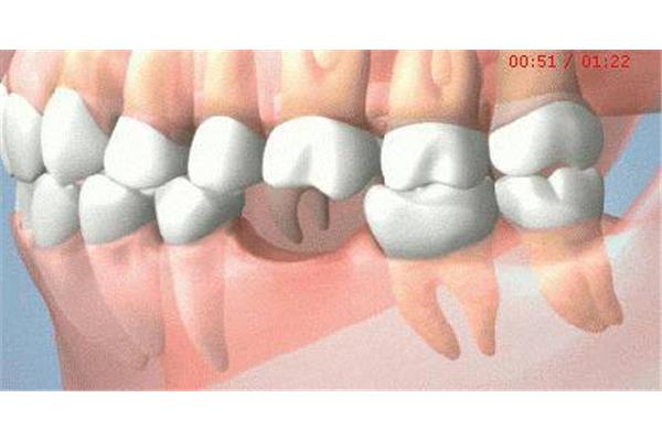 牙齒掉多久可以補牙?一般來說三個月后可以恢復正常