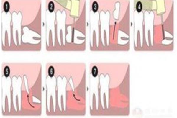 拔完牙齒多久可以漱口?一般需要多久