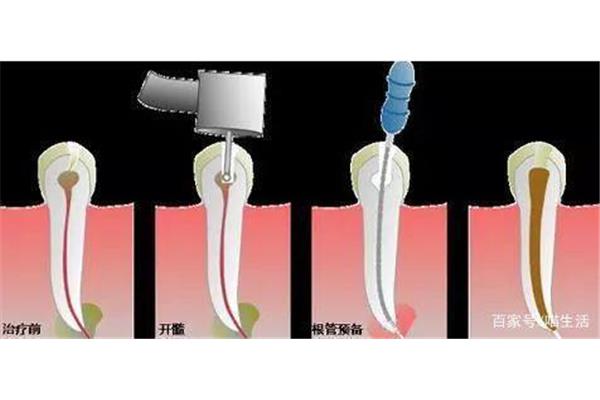 牙齒根管治療有多疼?一般兩三天即可不痛