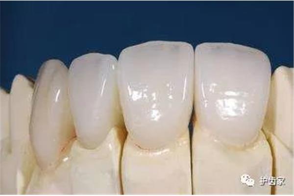 全瓷牙的大牙能活多久,全瓷牙能活多久?