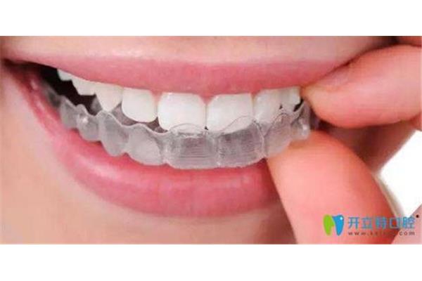 正畸牙齒帶牙套會痛多久?專家:剛戴上隱形牙套不會痛