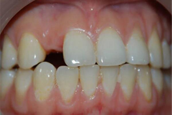 牙齦萎縮怎么辦?可以恢復嗎?