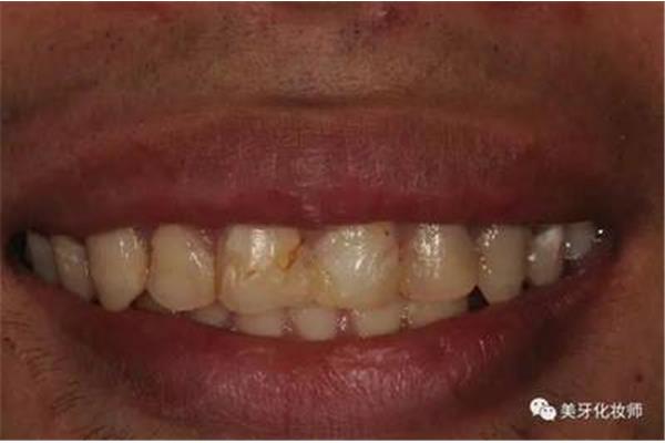 補門牙的樹脂多久會脫落,補一顆門牙要多少錢?