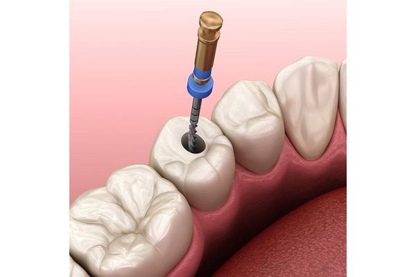蛀牙蔓延至牙髓:牙齒出現明顯蛀洞