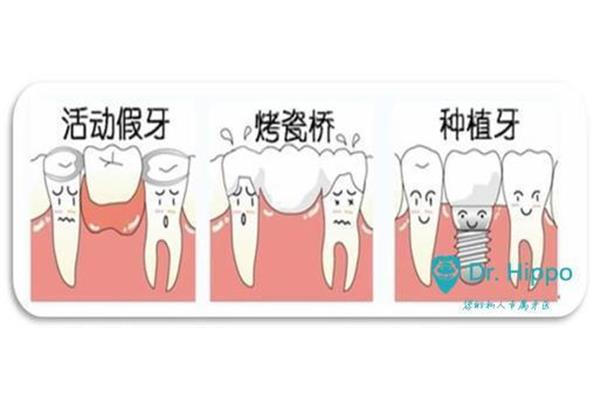 補一顆假牙能用多久