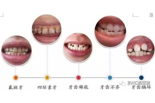 拔牙到箍牙的間隔時間有何不同?