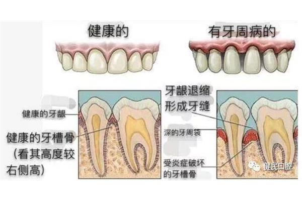 牙齒為何會出血?可能是牙齦有炎癥