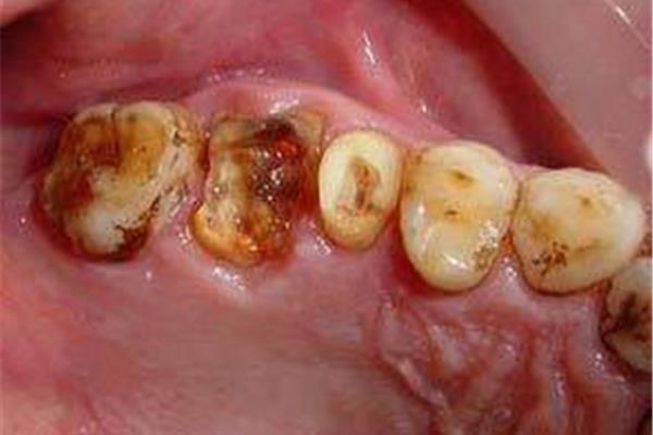 牙齒變成蛀牙的過程是怎樣的?