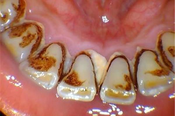 牙結石是細菌溫床還是病毒溫床?